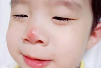 간호사 엄마가 알려주는 모기 기피제 사용법